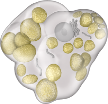 Swollen Gaucher cell due to the accumulation of a fatty substance known as glucocerebroside